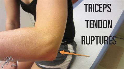 tricep tendon tear test|torn biceps tendon at shoulder.